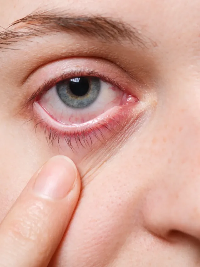 Eye Flu home remedies